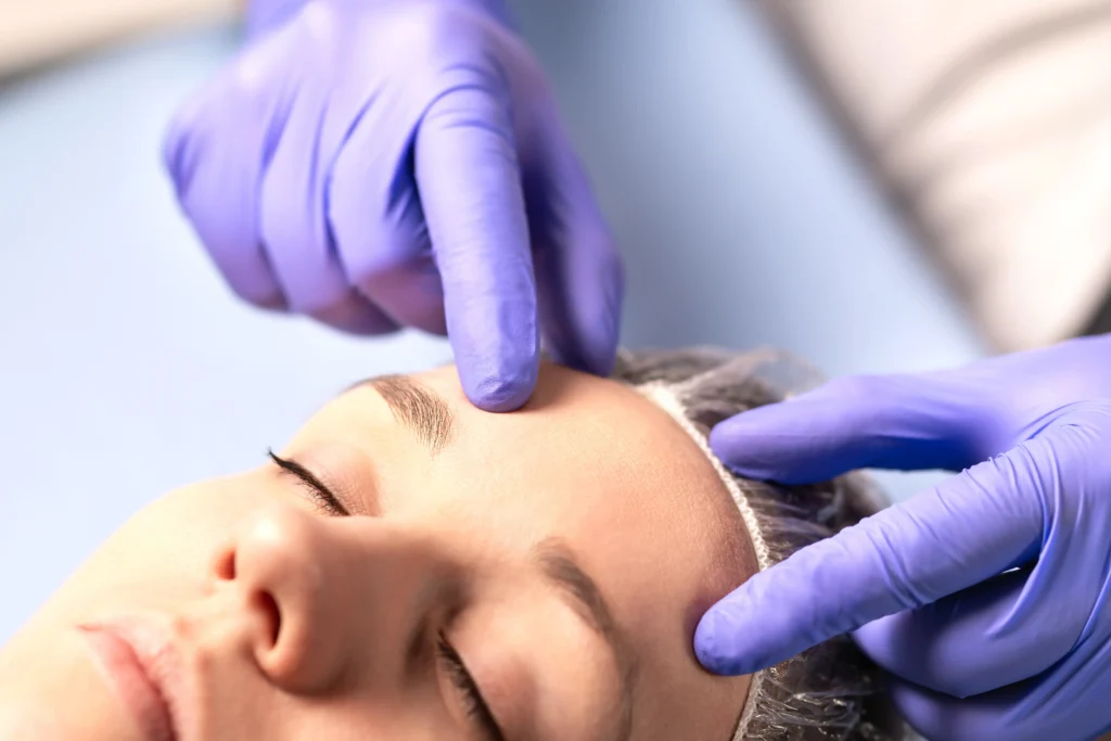 A clinician marking the forehead before a Botox treatment