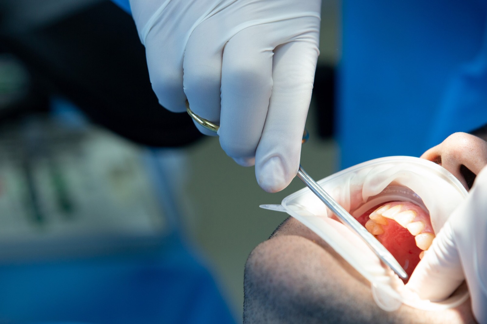 A dentist treating a patient's tooth during emergency pain management